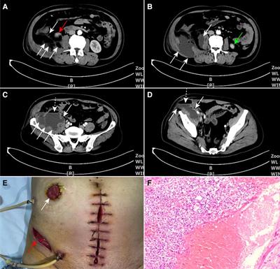 Colonoscopic titanium clipping to address appendiceal stump leakage: a case report